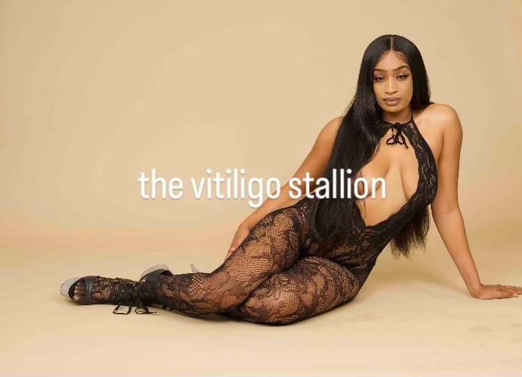 thevitiligostallion thumbnail