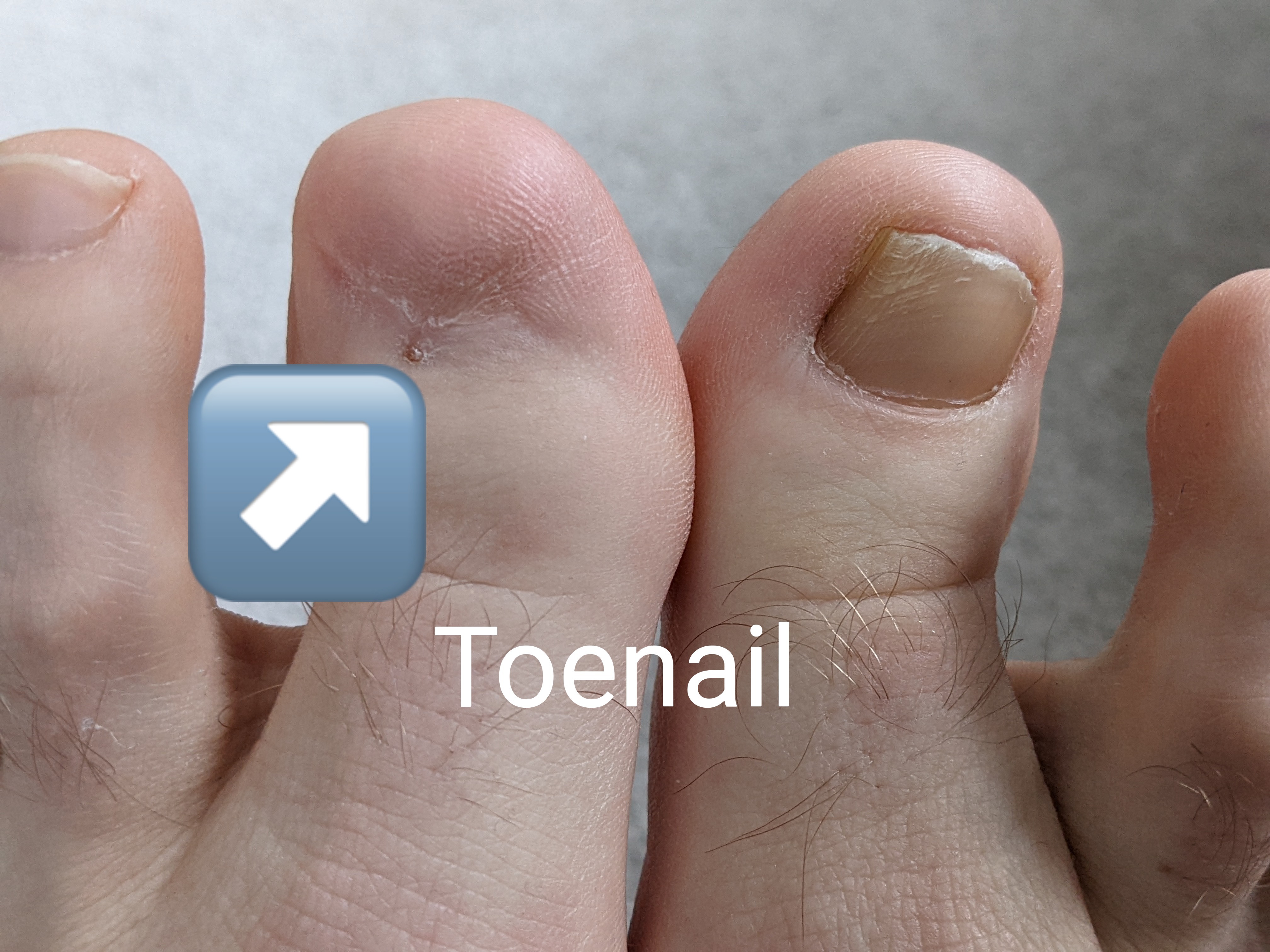 toenailguy thumbnail